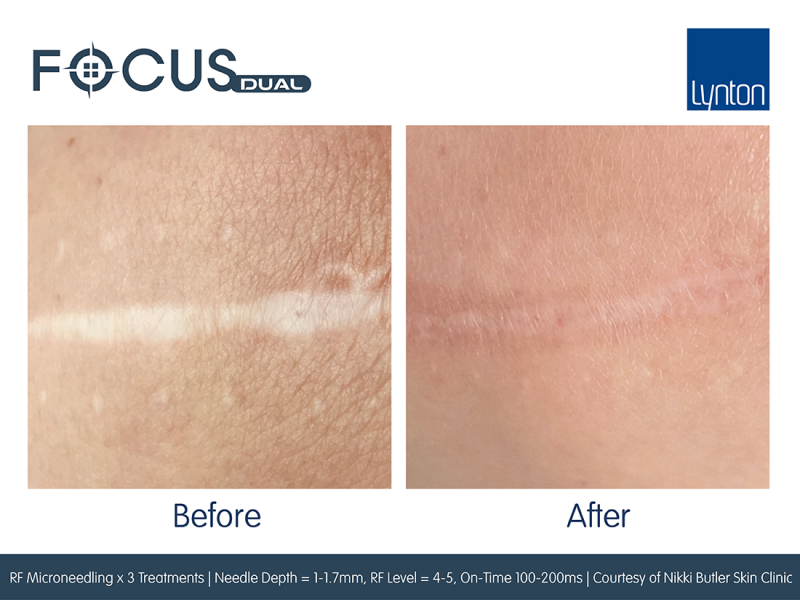 Focus-Dual-Before-and-After-3-RF-Microneedling-Treatments-Nikki-Butler-Skin-Clinic (1)