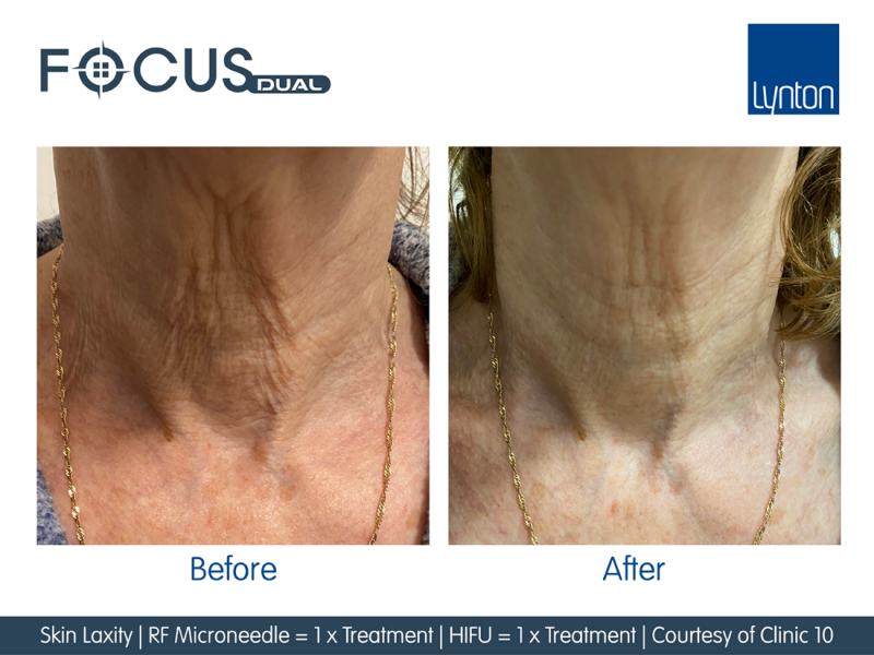 Skin Laxity on Neck - Before and After 1 Focus Dual HIFU and 1 RF Microneedling Treatments