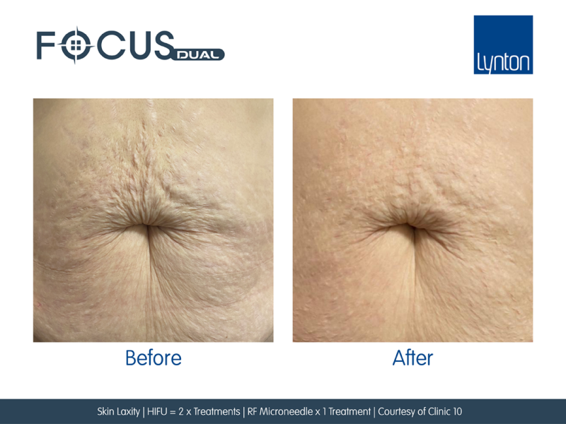 Skin Laxity on Stomach - Before and After 2 Focus Dual HIFU and 1 RF Microneedling Treatments